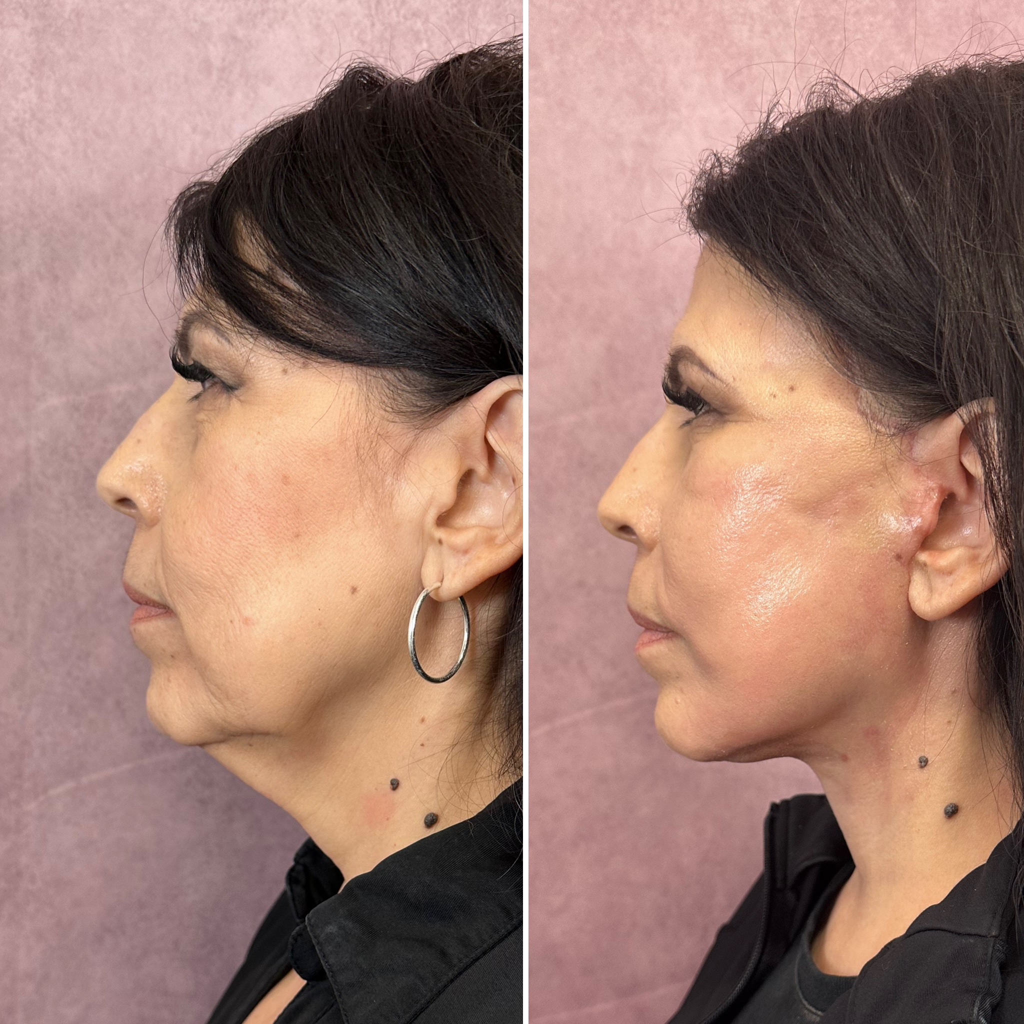 Before and after &mdash; deep plane facelift and deep neck lift · profile view