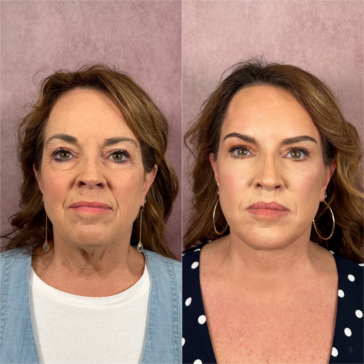 Brow Lift as part of The Masterpiece Surgery&trade; &mdash; featured patient · frontal view