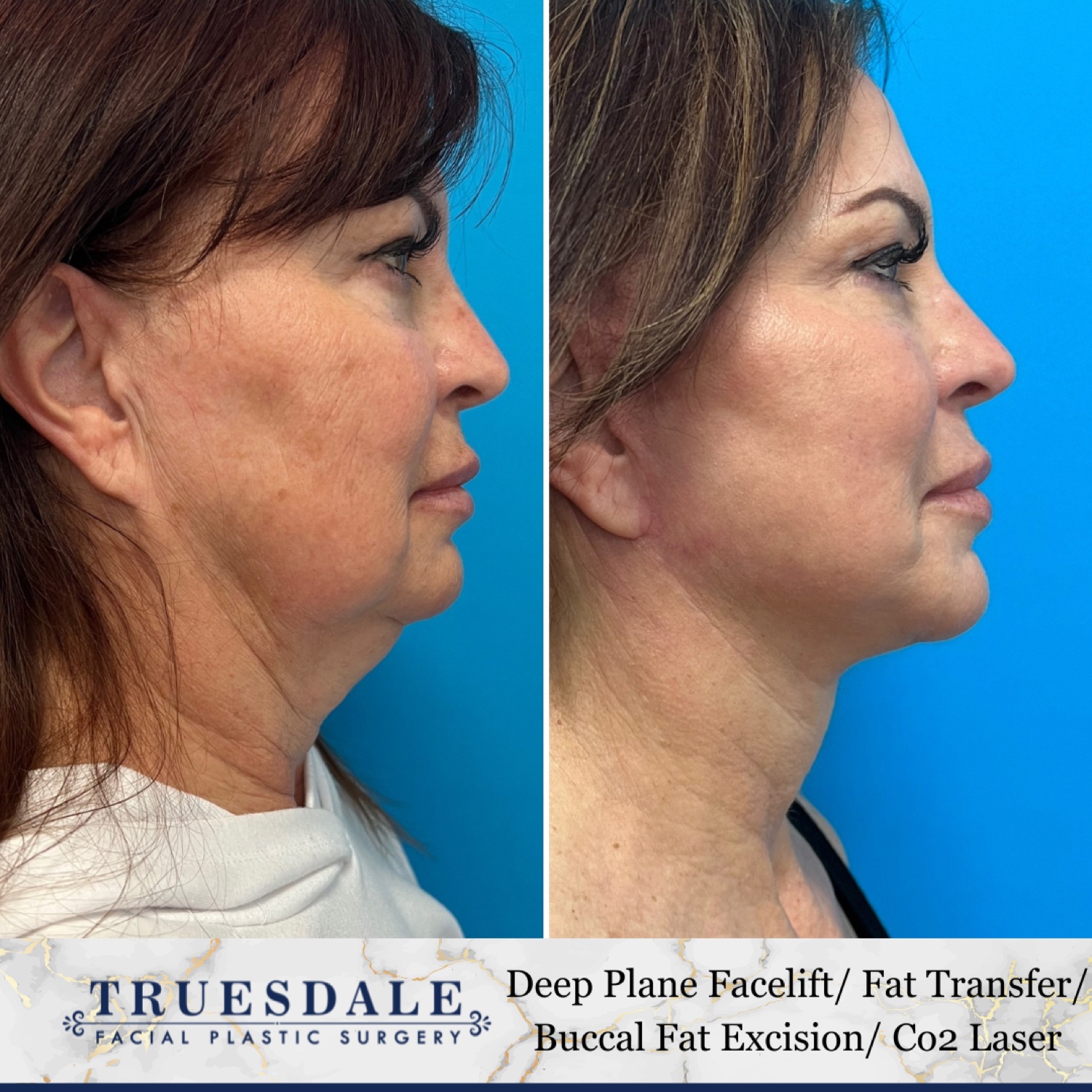 Before and after &mdash; deep neck lift as part of The Masterpiece, frontal view