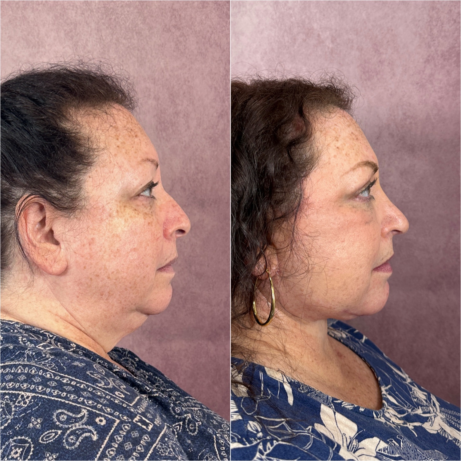 Before and after &mdash; deep neck lift as part of The Masterpiece, frontal view