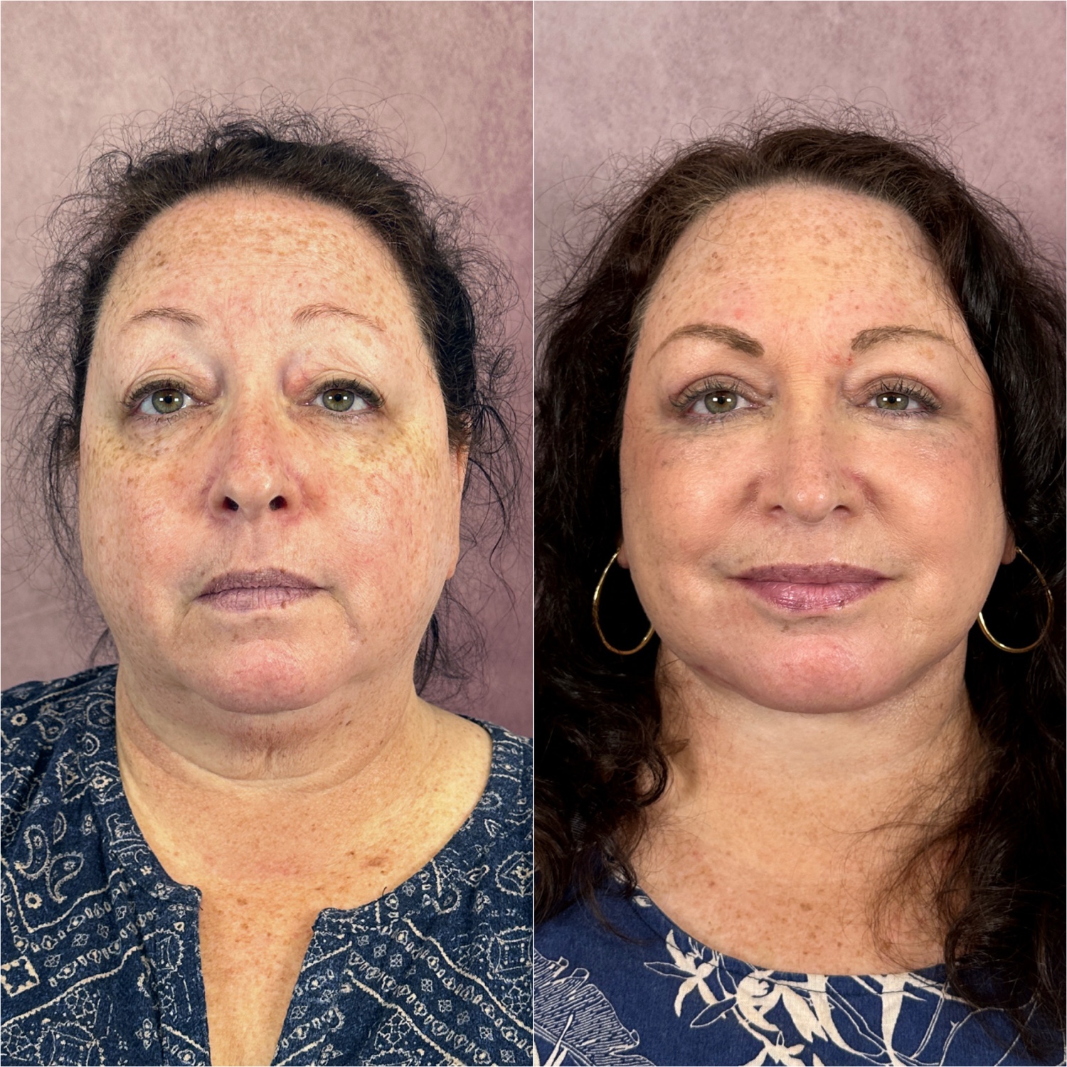 Deep Neck Lift as part of The Masterpiece Surgery&trade; before and after · oblique view