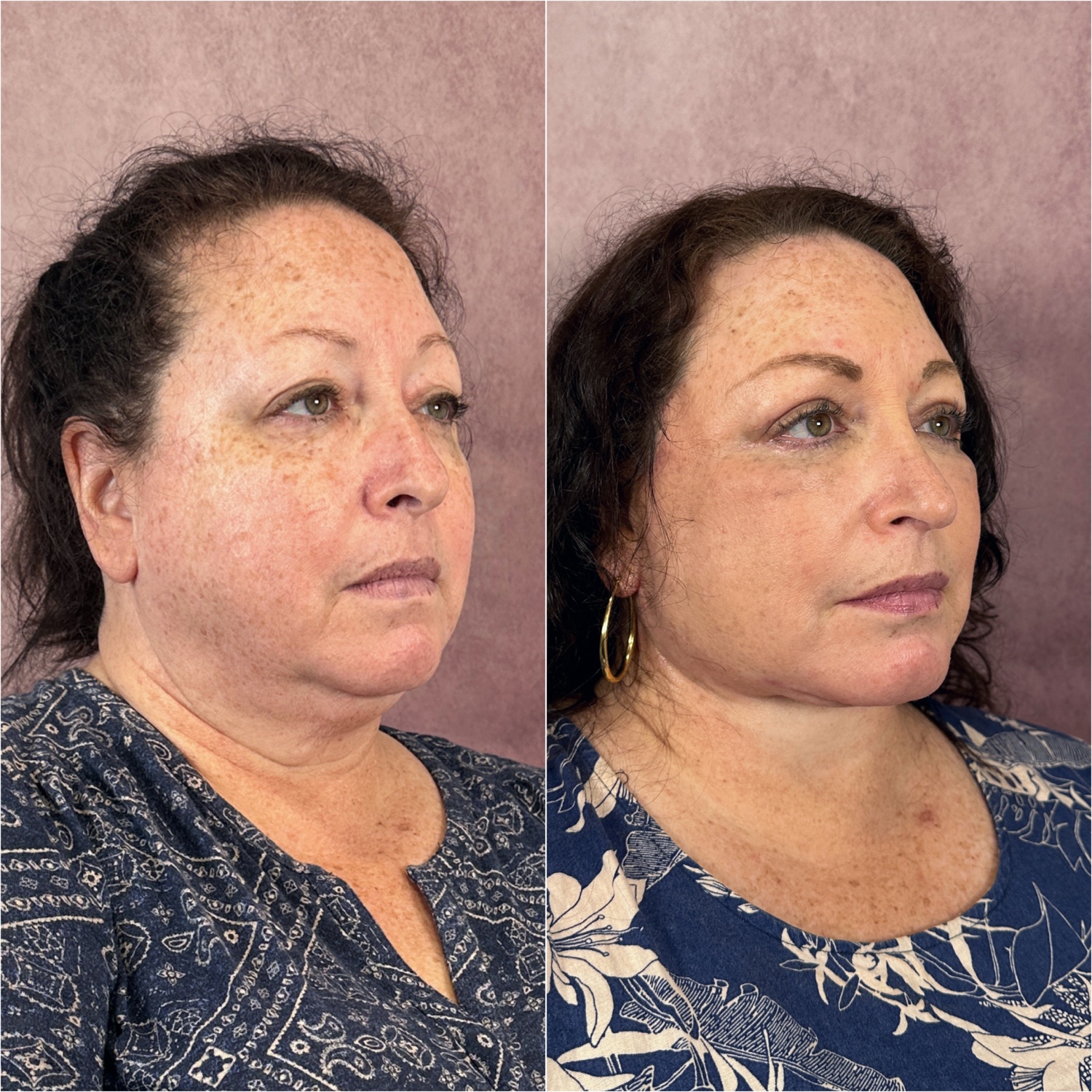 Before and after &mdash; deep neck lift as part of The Masterpiece, profile view