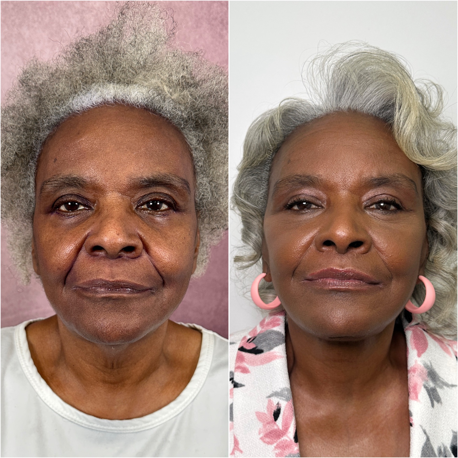 Before and after &mdash; deep neck lift as part of The Masterpiece, frontal view