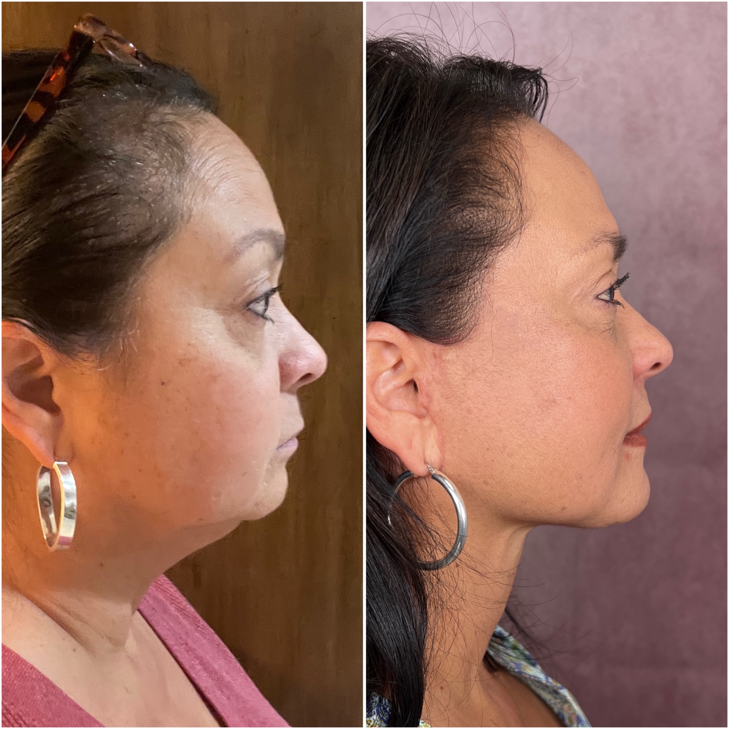 Before and after &mdash; deep neck lift as part of The Masterpiece, frontal view