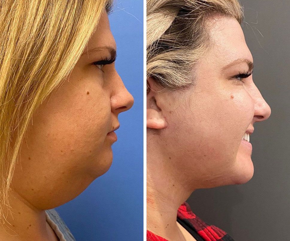 Before and after &mdash; deep neck lift · before and after composite
