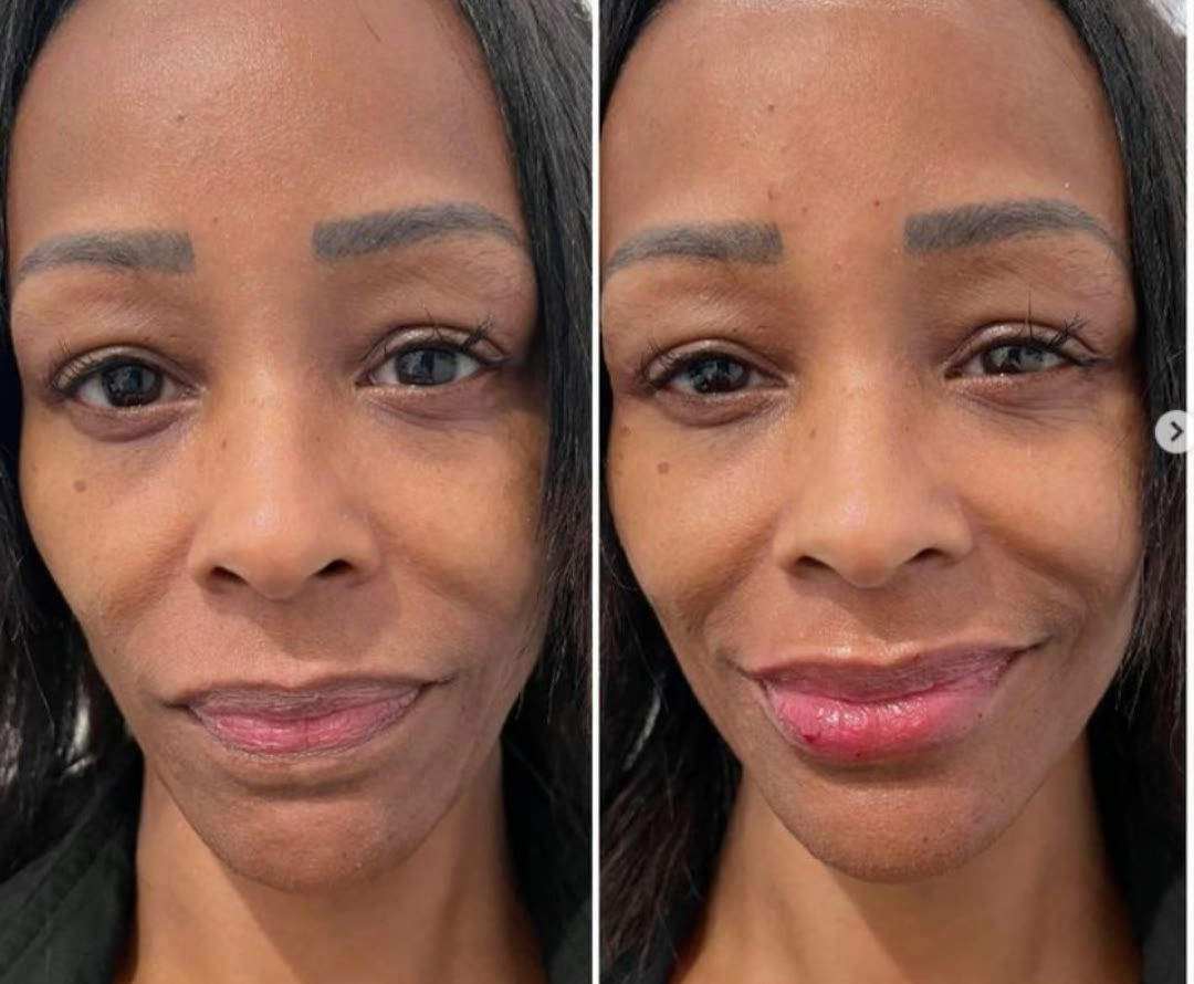 Lip filler before and after, frontal view