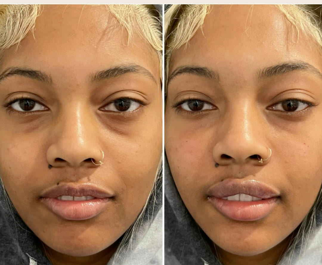 Undereye filler before and after · before and after composite