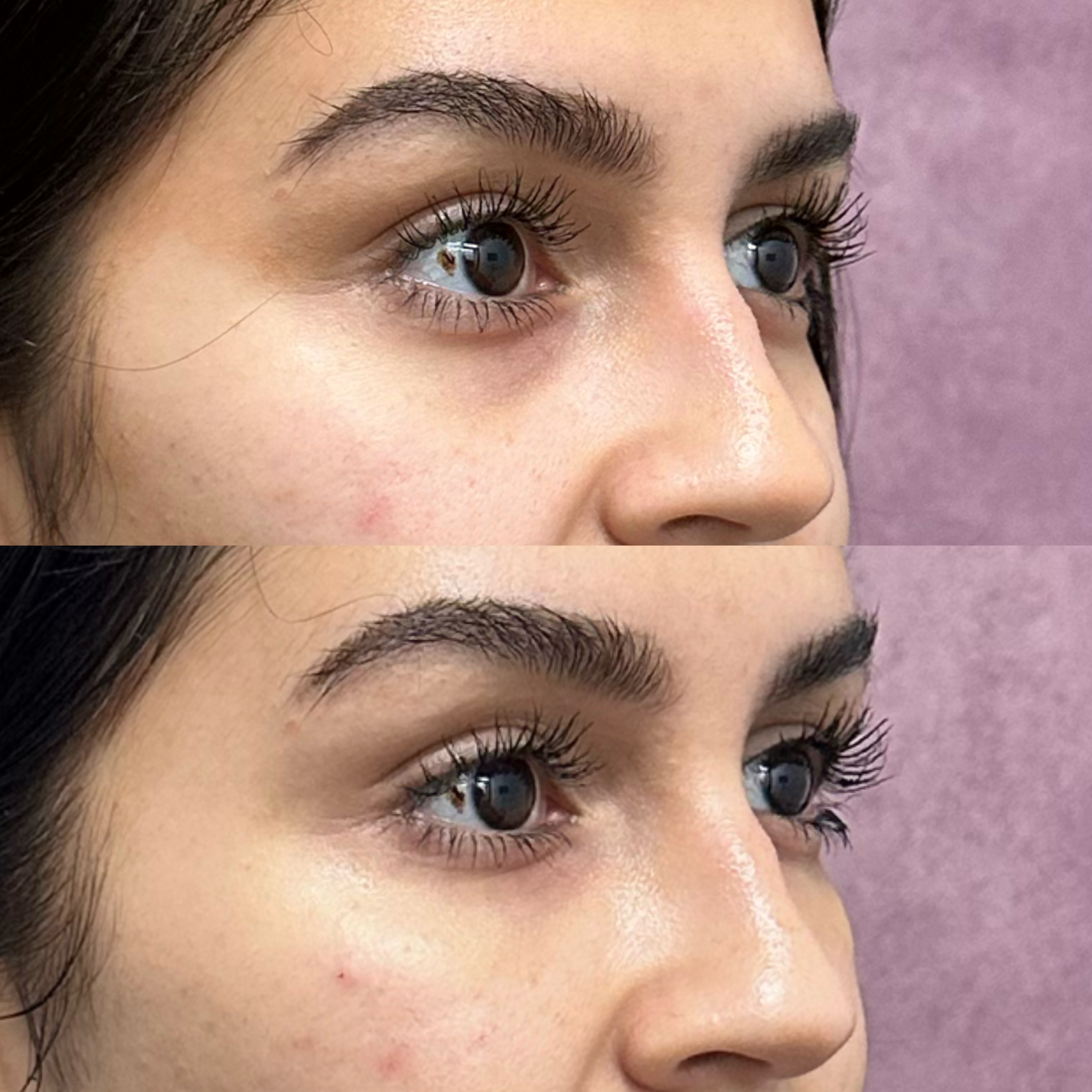 Dermal filler before and after · before and after composite