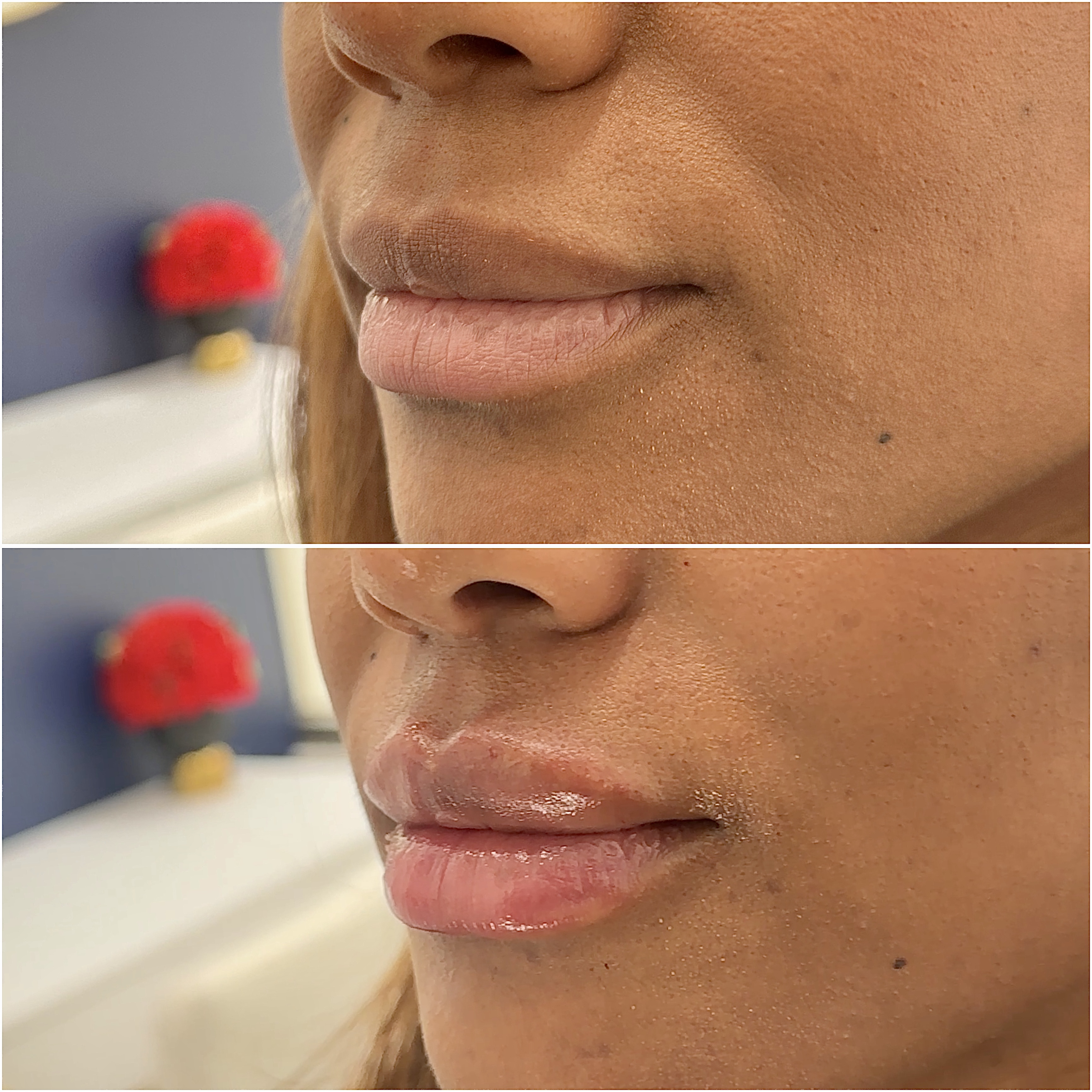 Dermal filler before and after · before and after composite