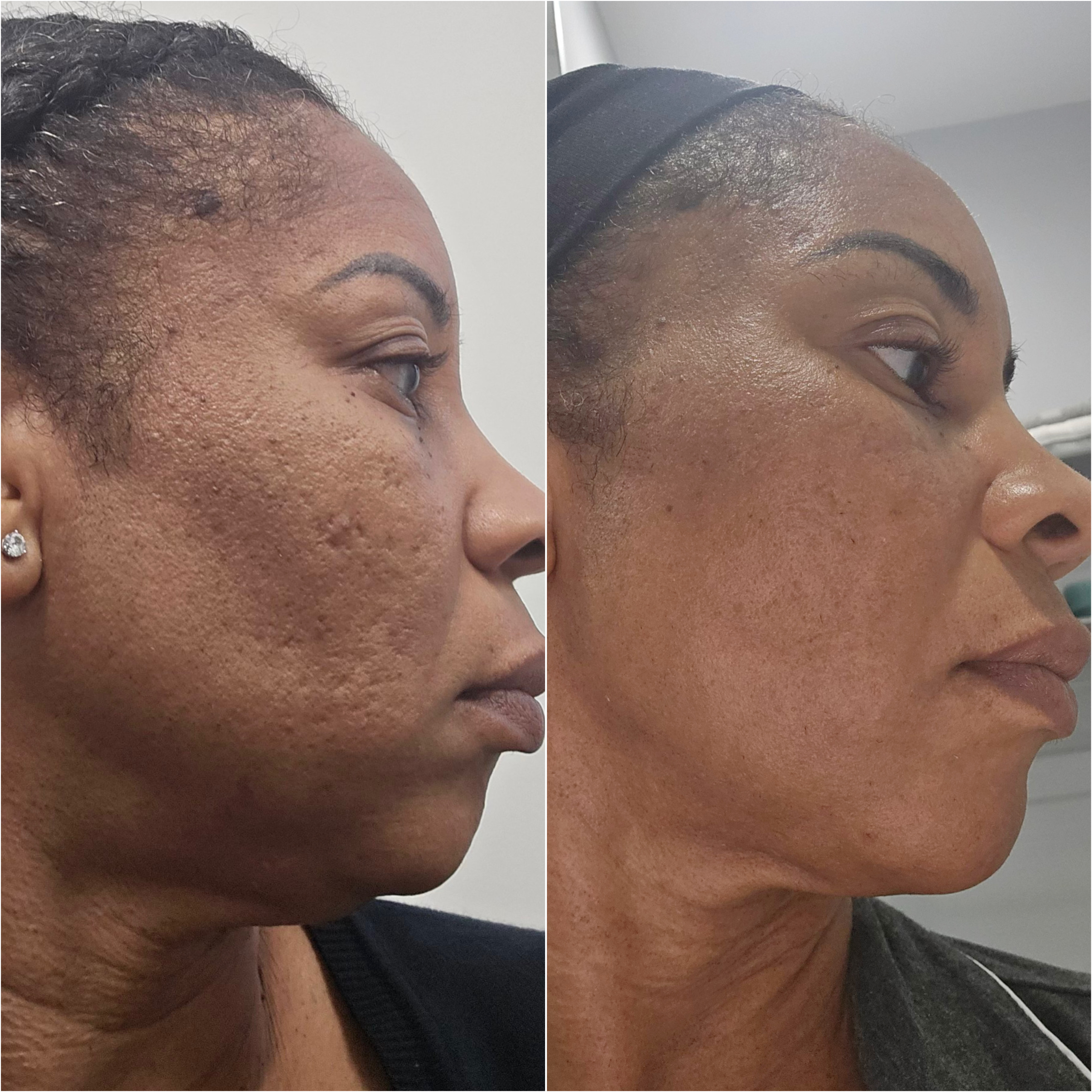 UltraClear laser before and after · before and after composite