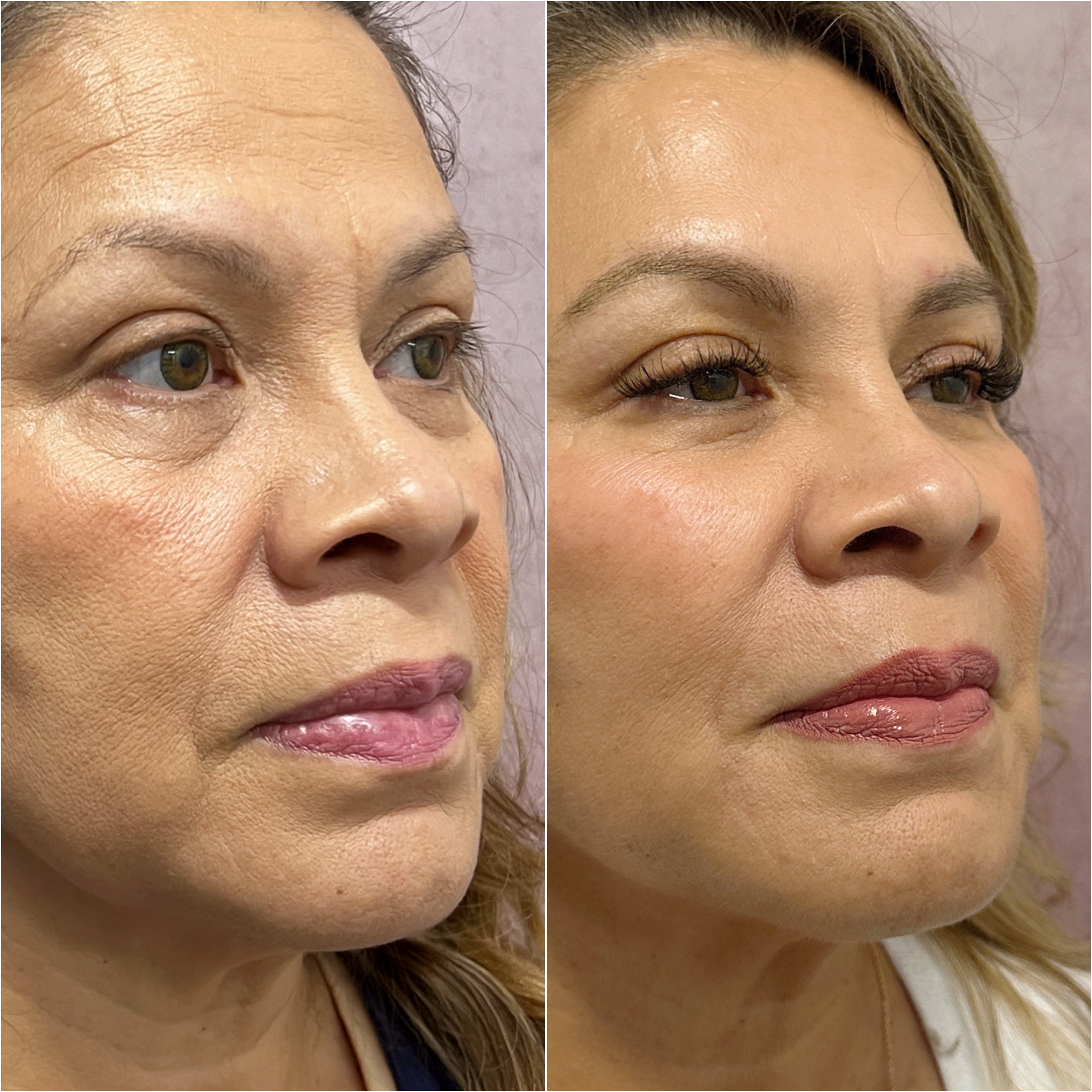UltraClear laser before and after · before and after composite
