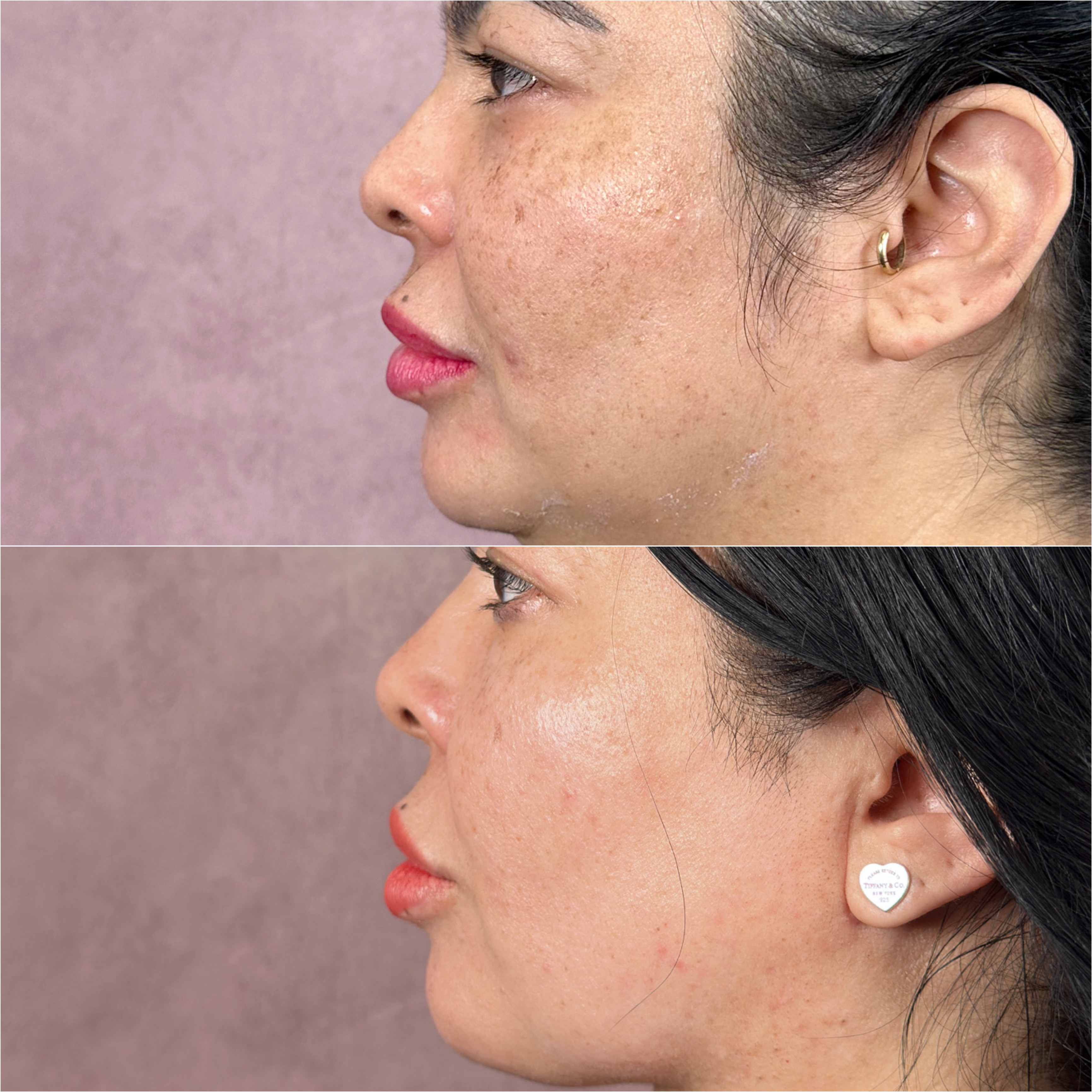 UltraClear laser before and after · before and after composite