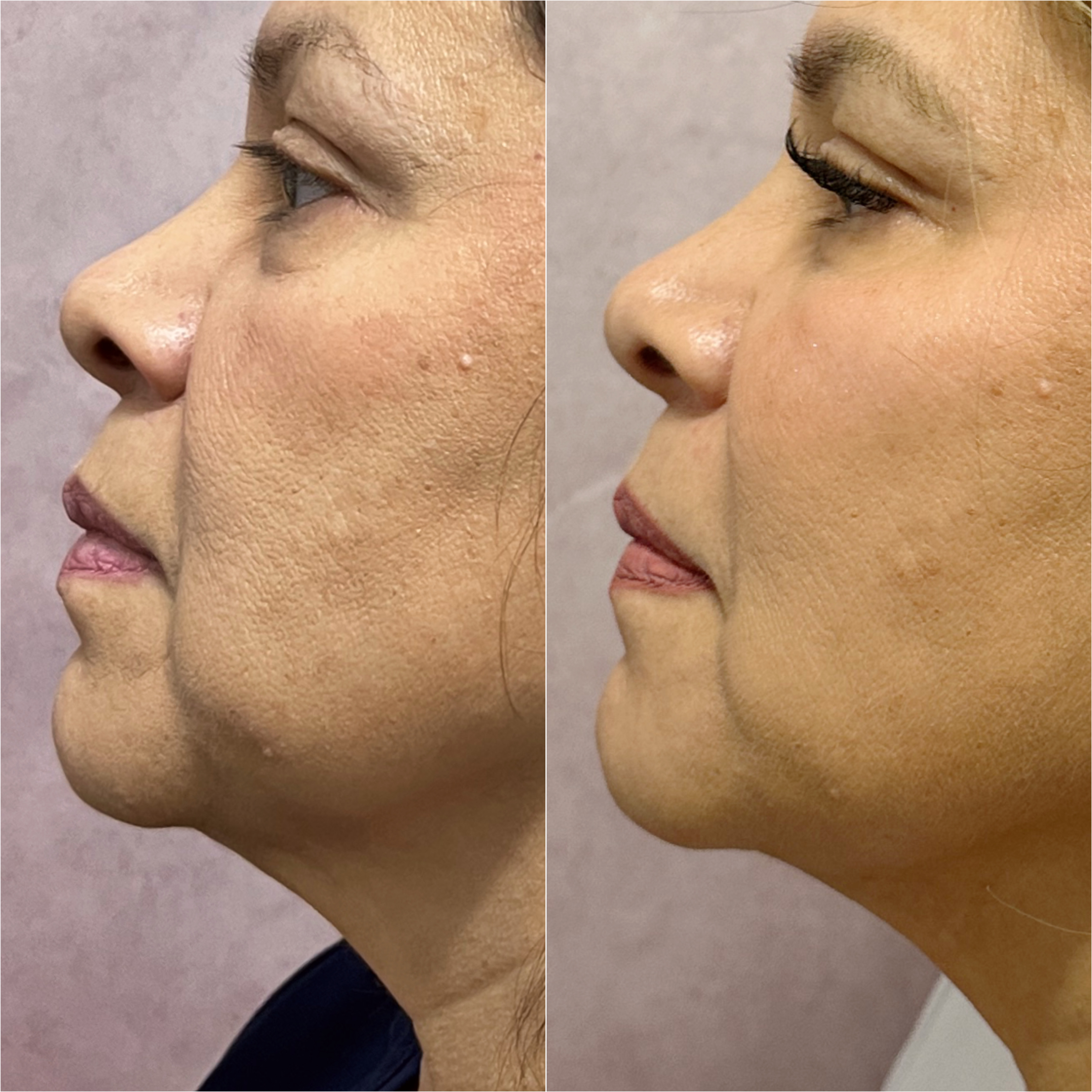 UltraClear laser before and after · before and after composite