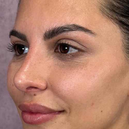Featured patient before and after - Rhinoplasty · before and after composite
