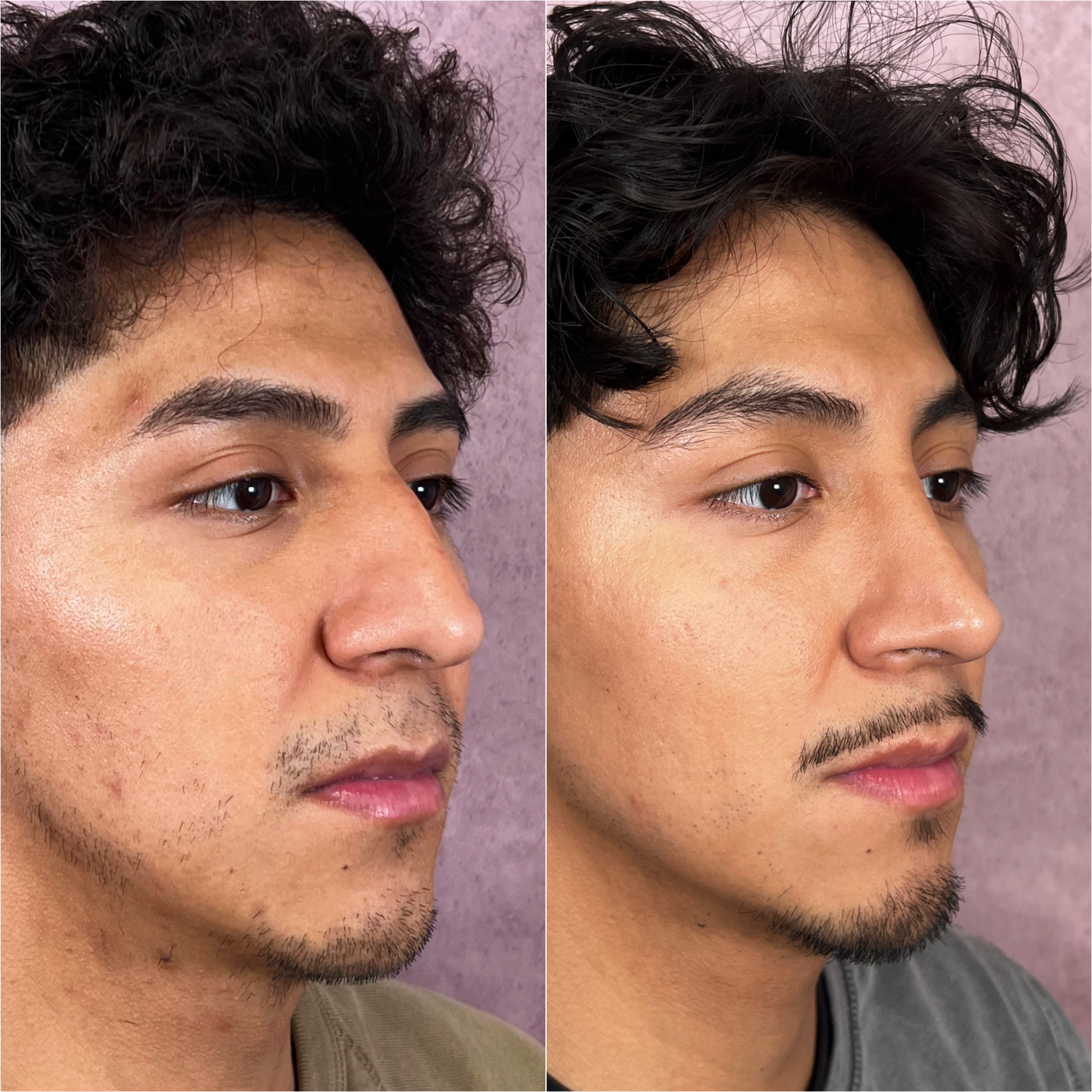 Before and after — primary rhinoplasty · profile view