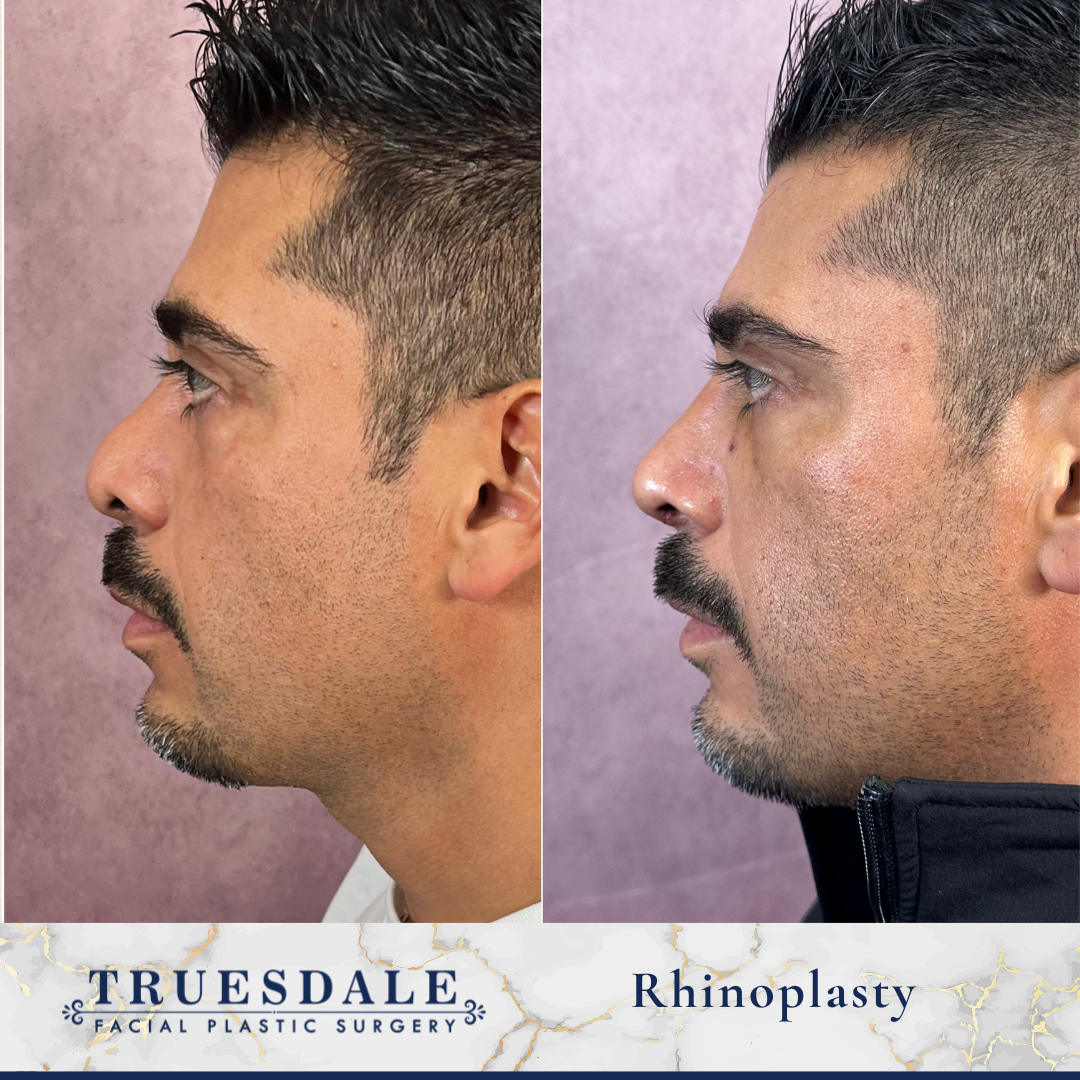 Before and after — male rhinoplasty, profile view