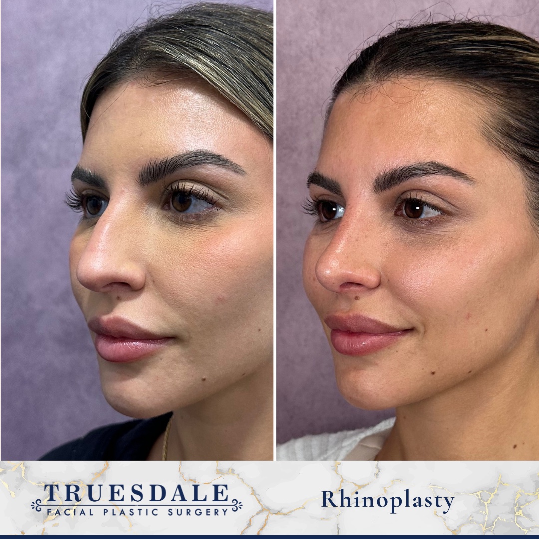 Before and after &mdash; rhinoplasty, oblique view