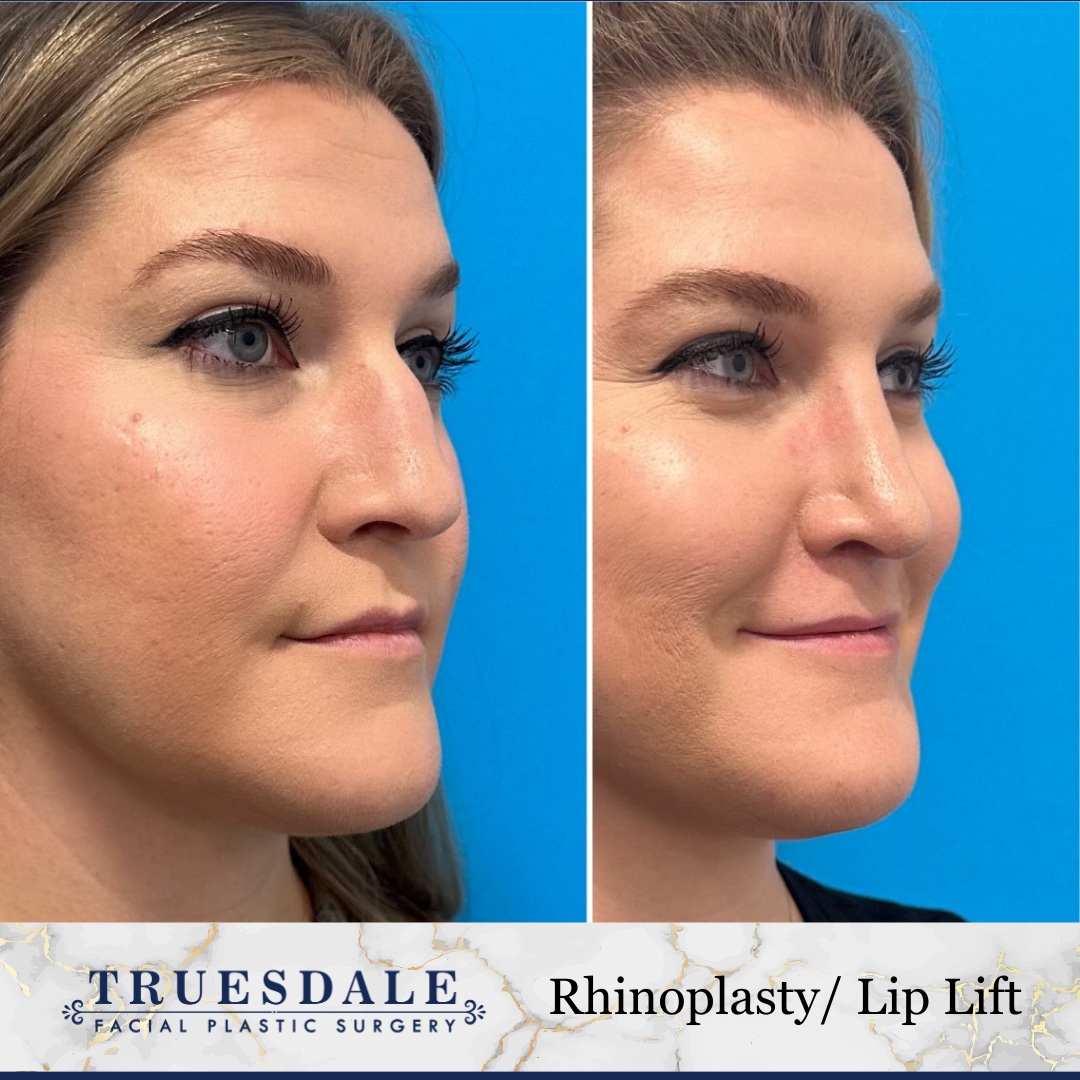 Before and after &mdash; rhinoplasty and lip lift, oblique view