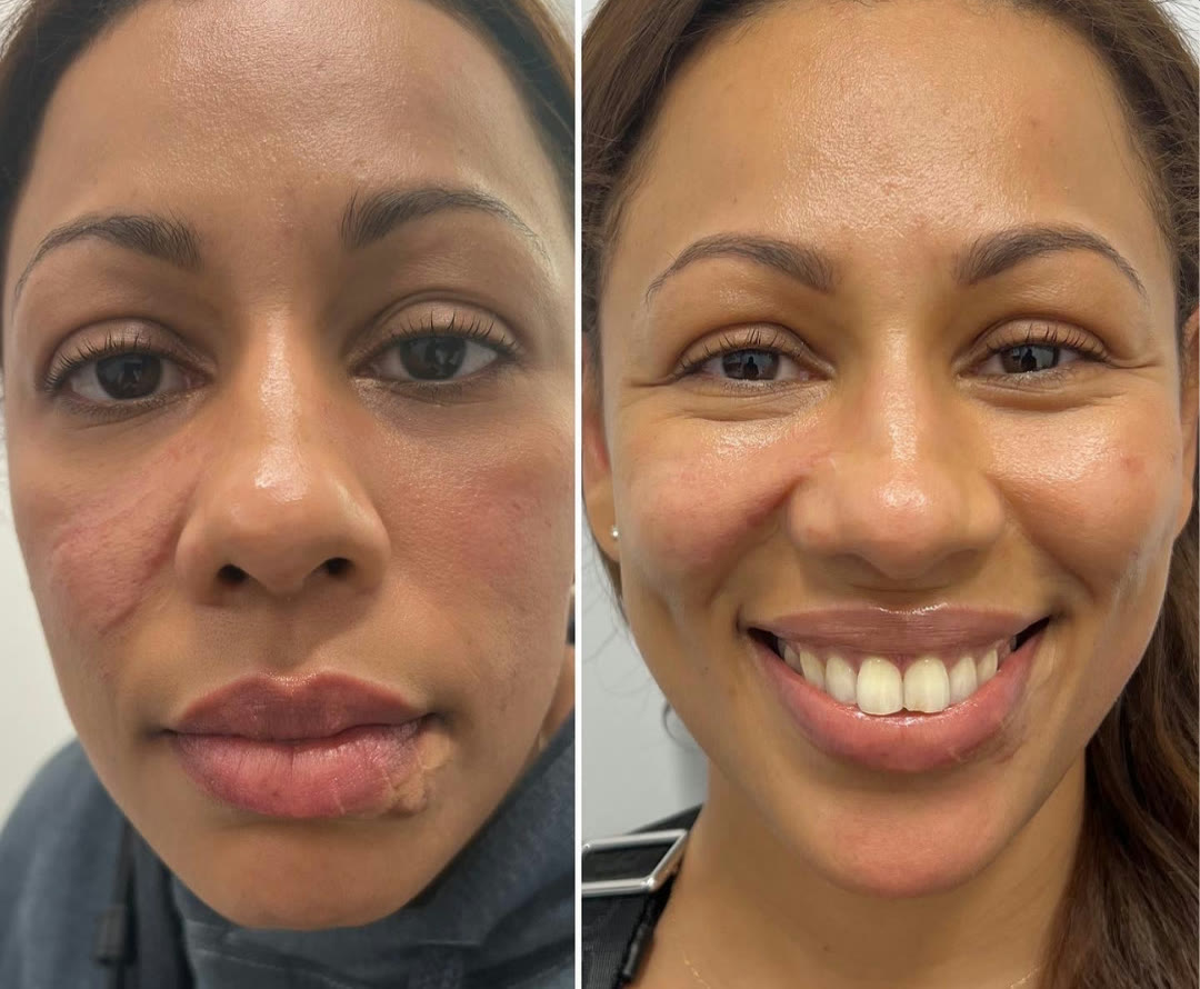 Scar Revision before and after · before and after composite
