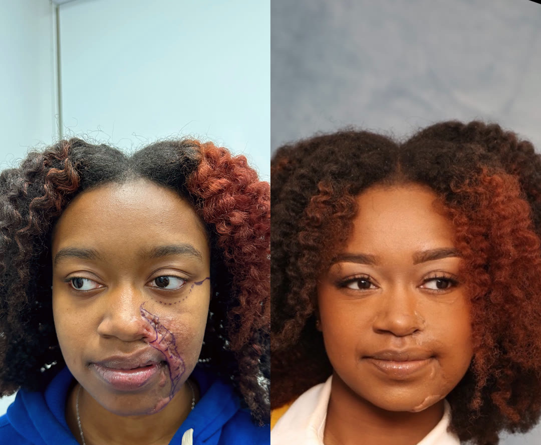 Scar Revision before and after · before and after composite