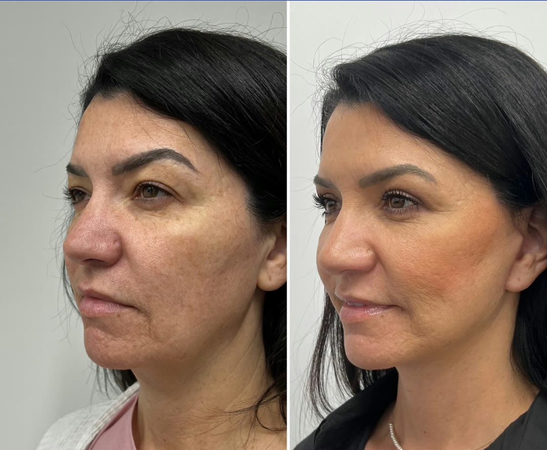 Upper blepharoplasty as part of The Masterpiece — deep plane facelift, neck lift, fat transfer, upper bleph before and after · before and after composite