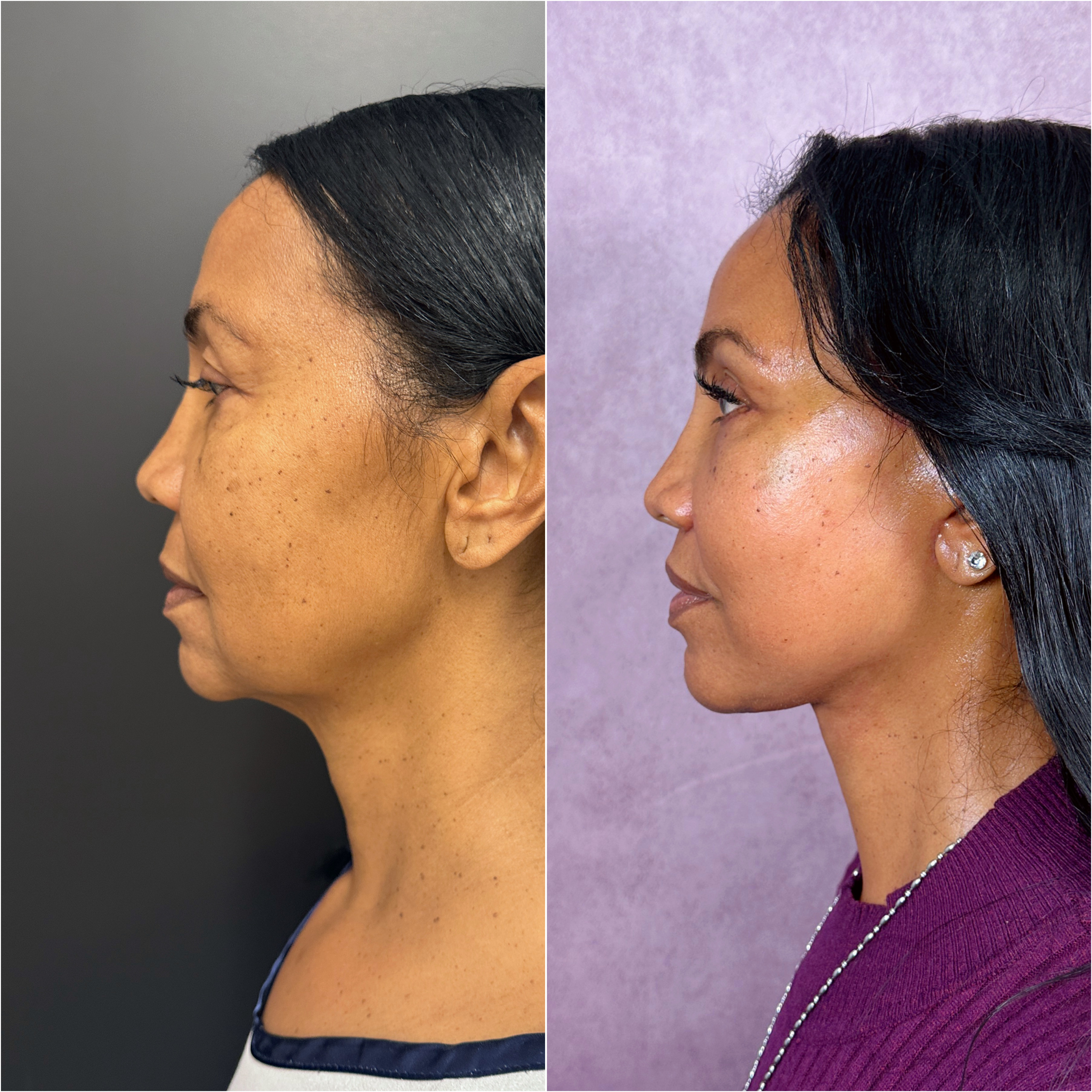 Lip Lift before and after &mdash; refined lip projection &middot; profile view