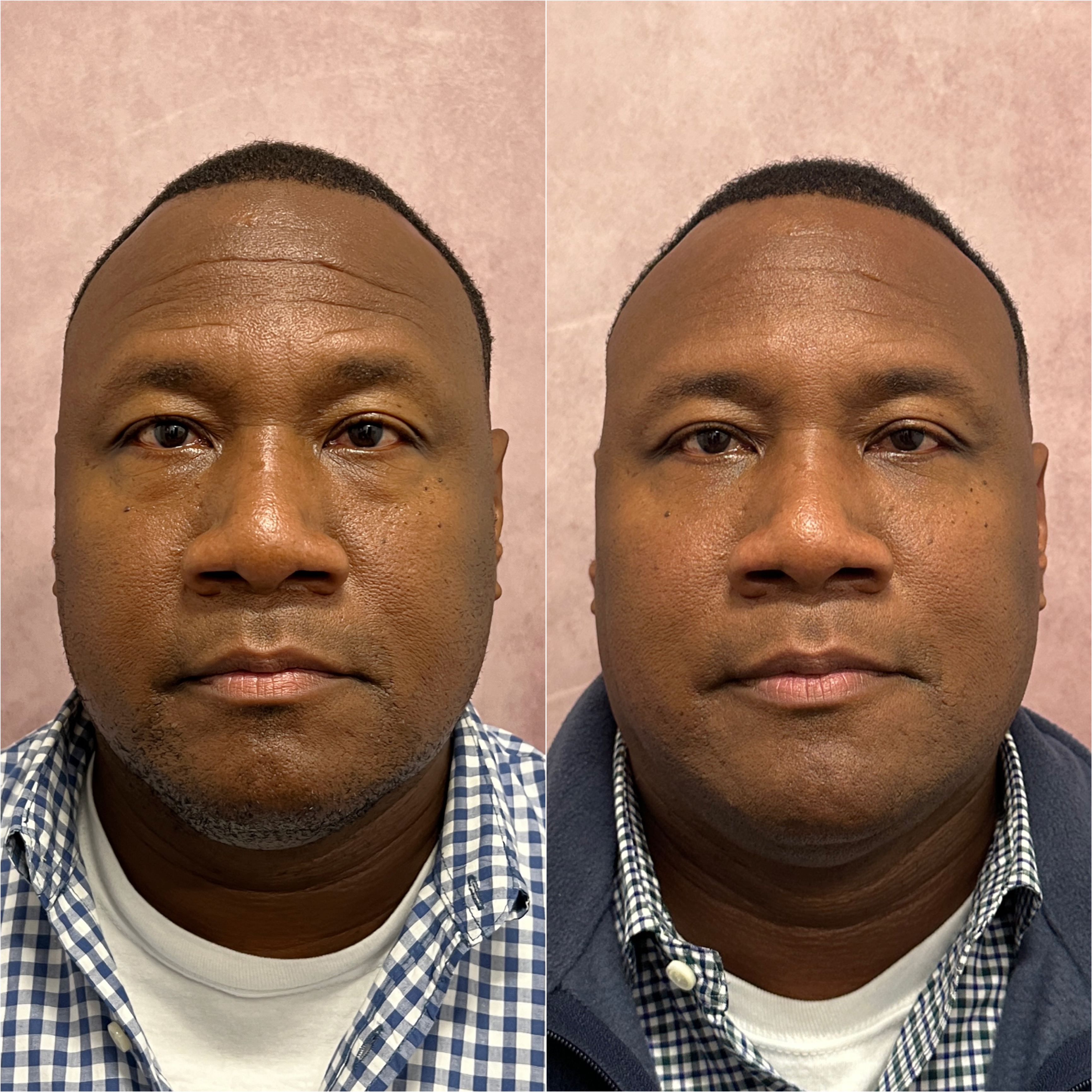 Lower blepharoplasty before and after
