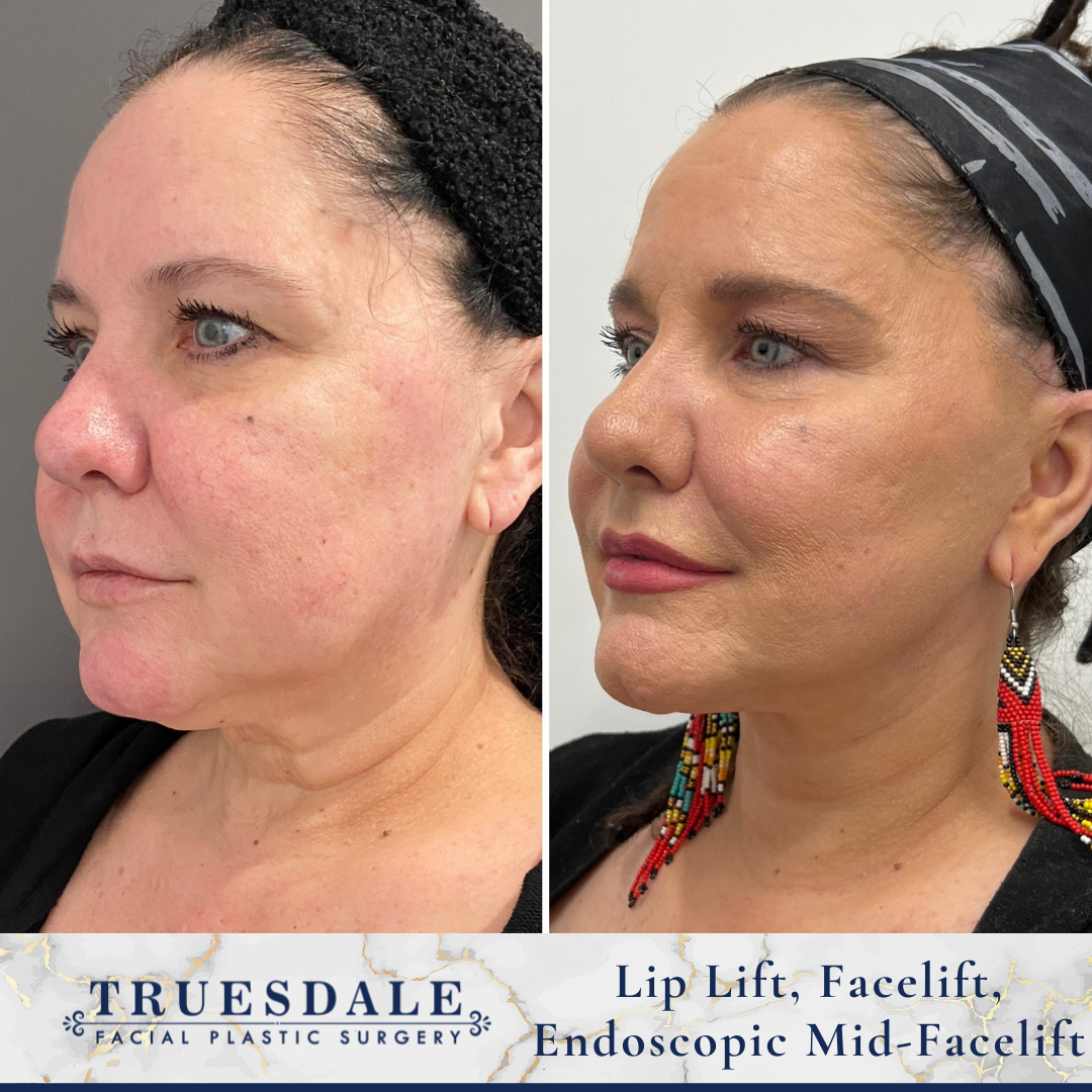 Facelift, Liplift, Endoscopic Mid-facelift