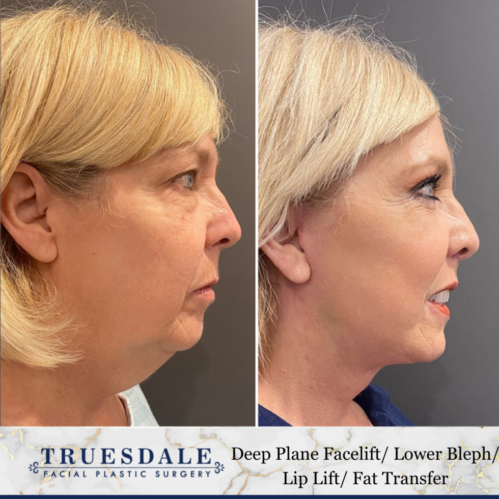 Facelift Beverly Hills Truesdale Facial Plastic Surgery 2256