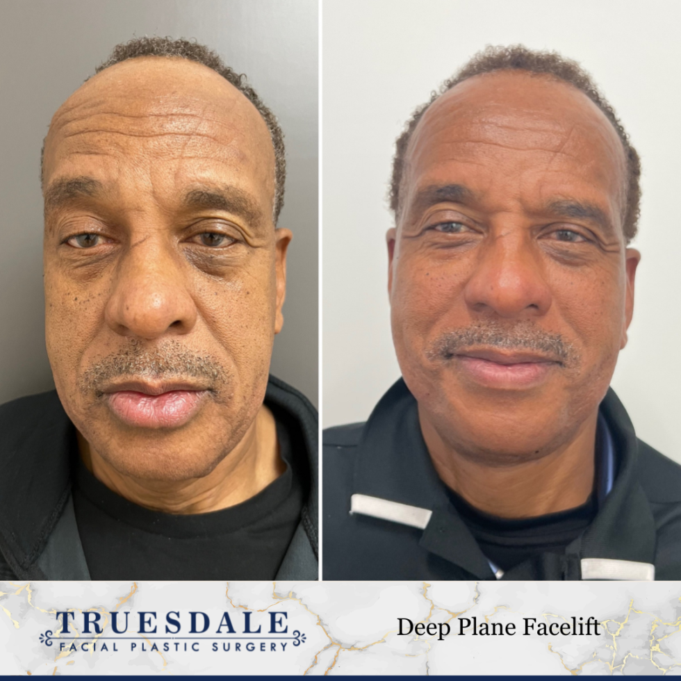 Facelift Beverly Hills Truesdale Facial Plastic Surgery 6057