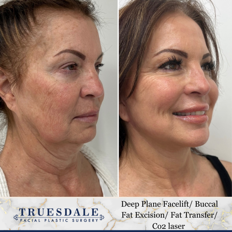 Facelift Beverly Hills Truesdale Facial Plastic Surgery 9186