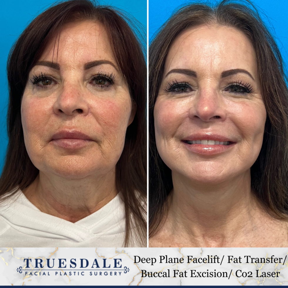 Laser Skin Resurfacing Co2 Beverly Hills Truesdale Facial Plastic Surgery 3748