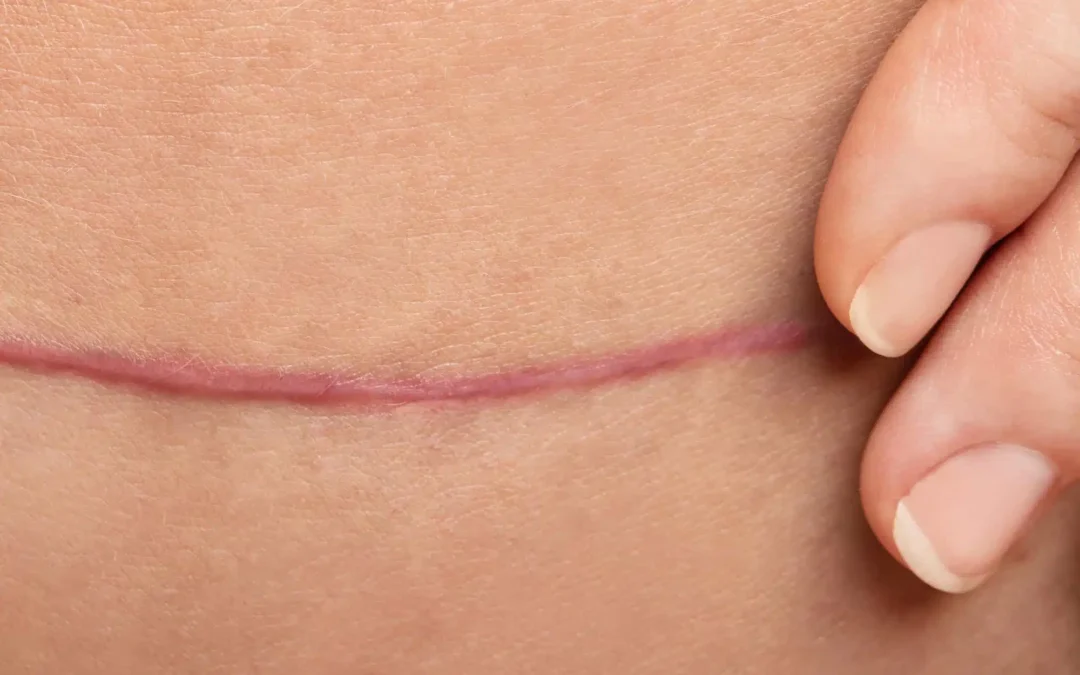 9 Things That Can Worsen Plastic Surgery Scars